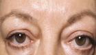 Causes of the appearance of morning edema under the eyes and how to treat them